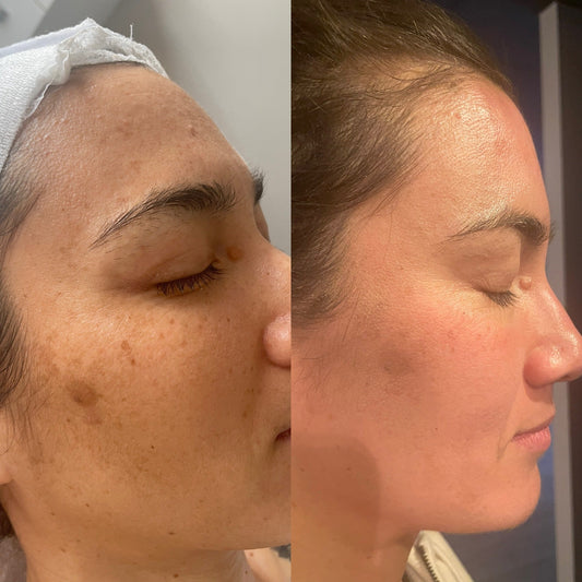 Dr Spiller Brisbane Facials