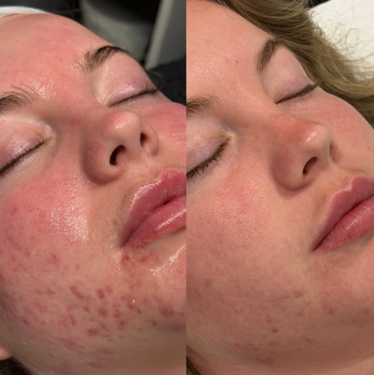 IDENEL - Glass Skin Reset Kit - Launch Price $540 (RRP $640)